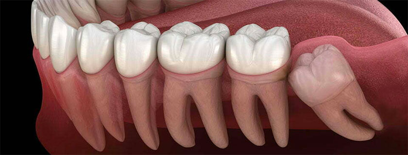 Gömülü Diş Tedavileri